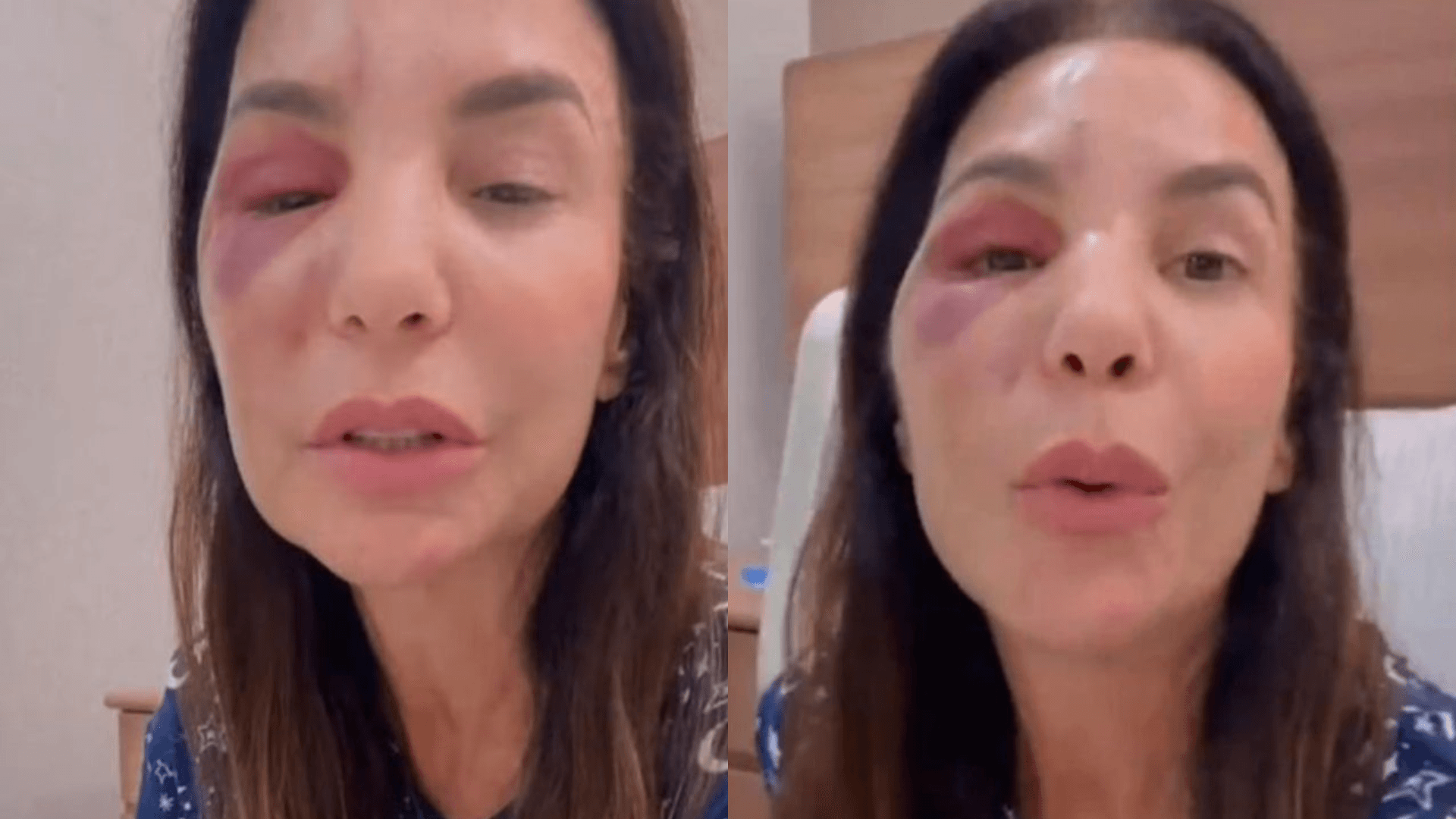 Ivete Sangalo passa por cirurgia após fraturar dois ossos do rosto
