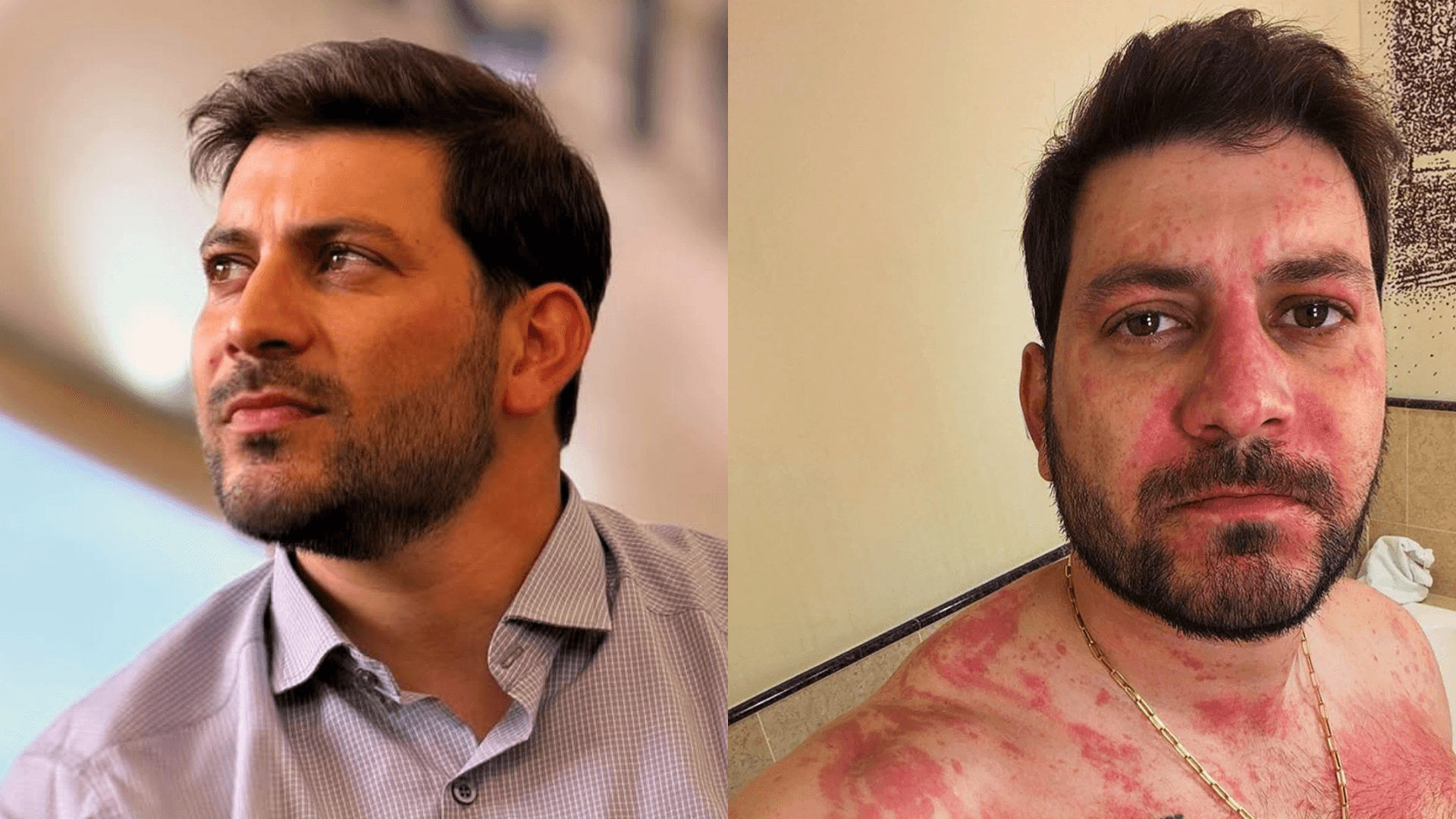Ex-BBB Caio Afiune vai parar no hospital após crise alérgica: “Nunca passei por um trem desses”