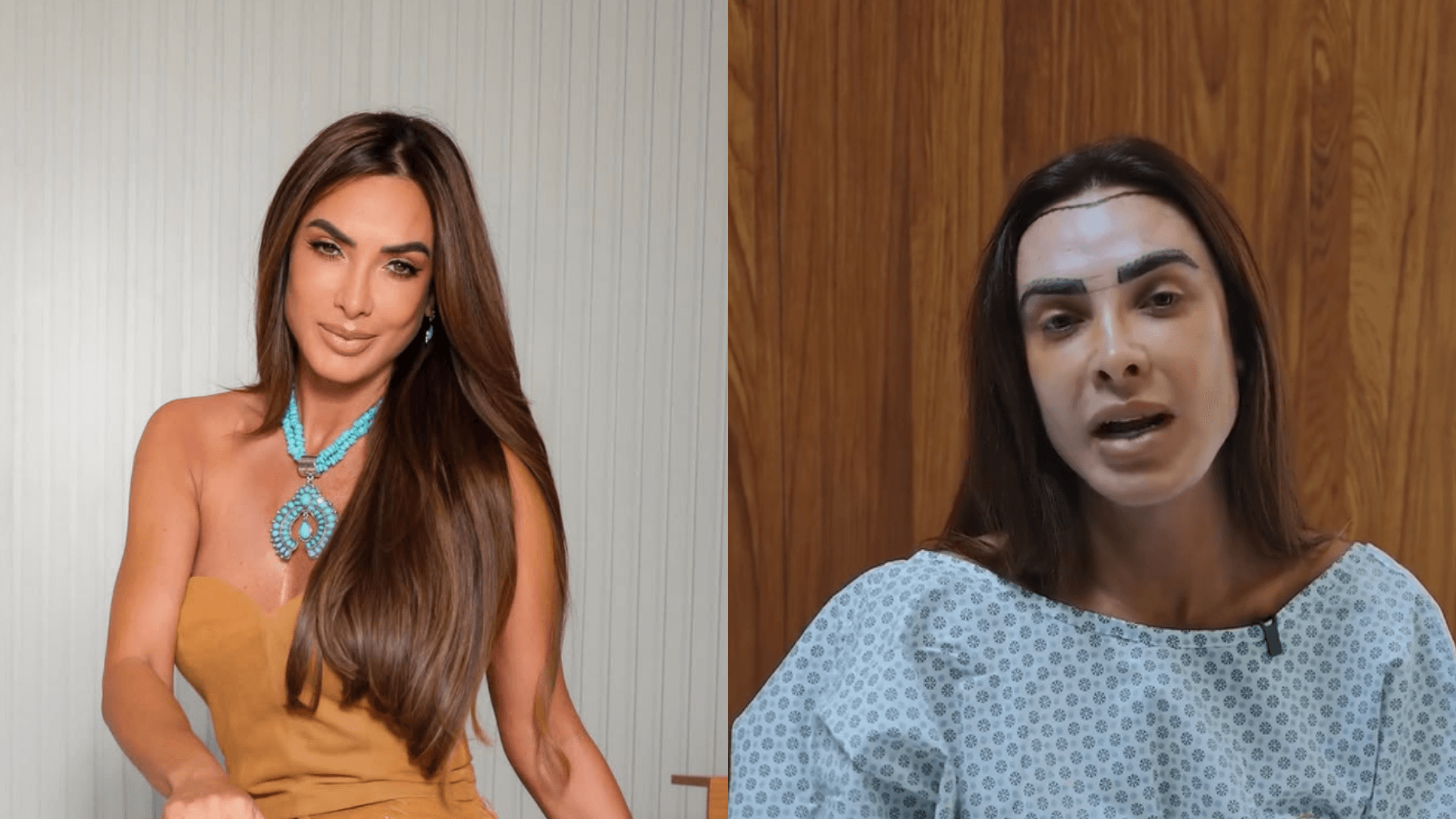 Nicole Bahls realiza transplante capilar após quadro de alopecia e declara: “Mais feliz e mais cabeluda”