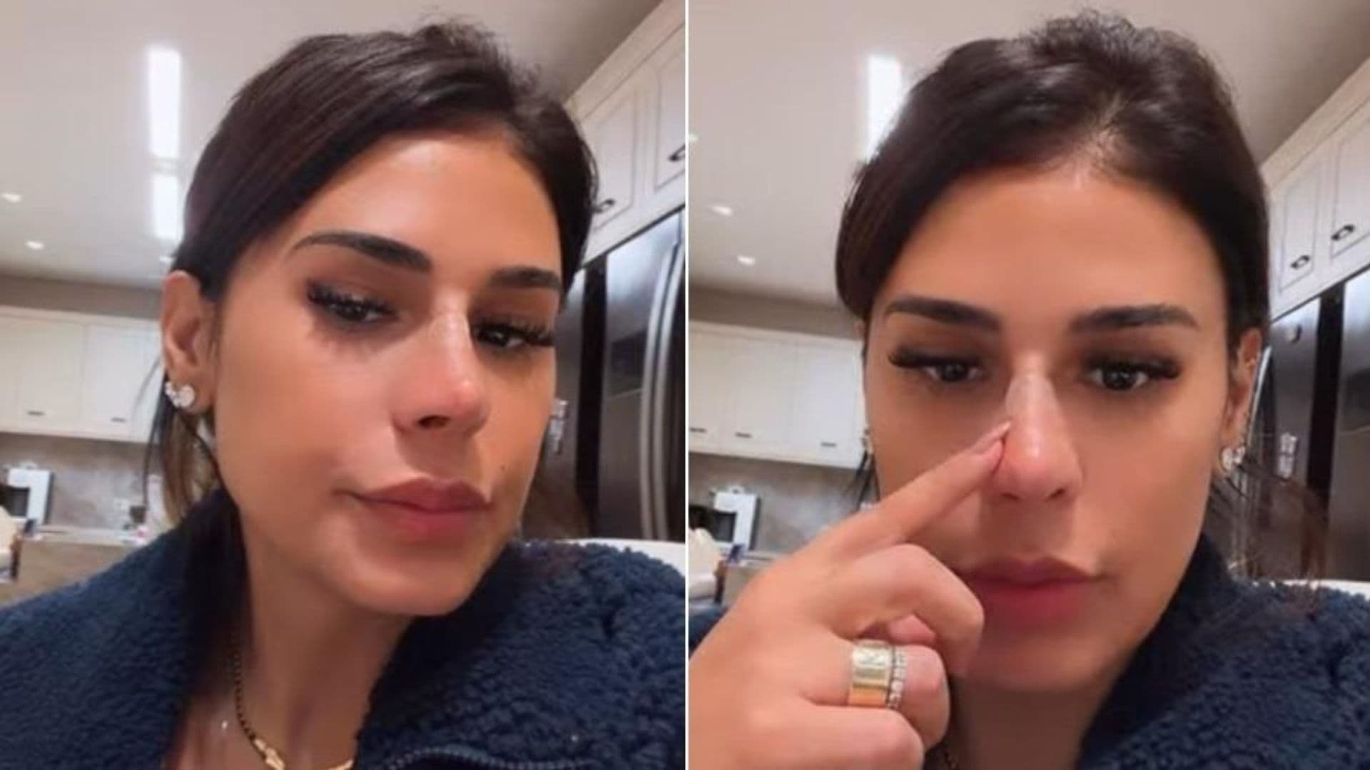 Não é rinoplastia! Simone Mendes explica procedimento estético no nariz